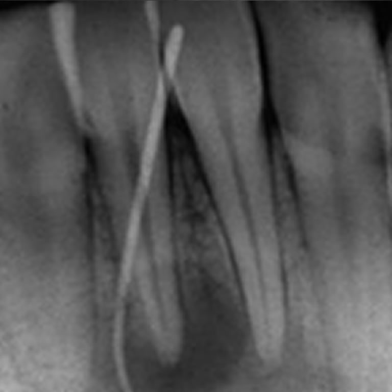 Cirugía complementaria