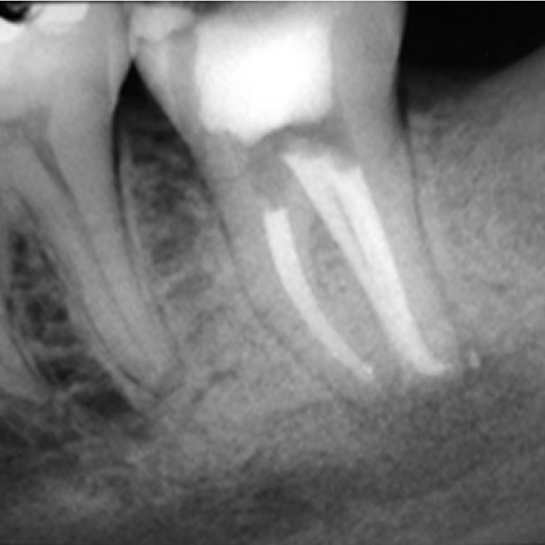 Segundo molar inferior izquierdo: conducto en C