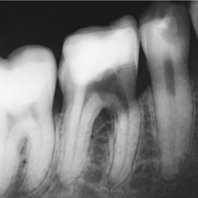 Segundo Premolar Inferior