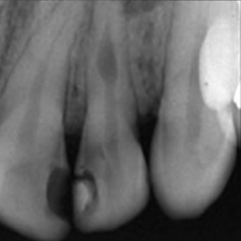 Reabsorción Dentinaria Interna
