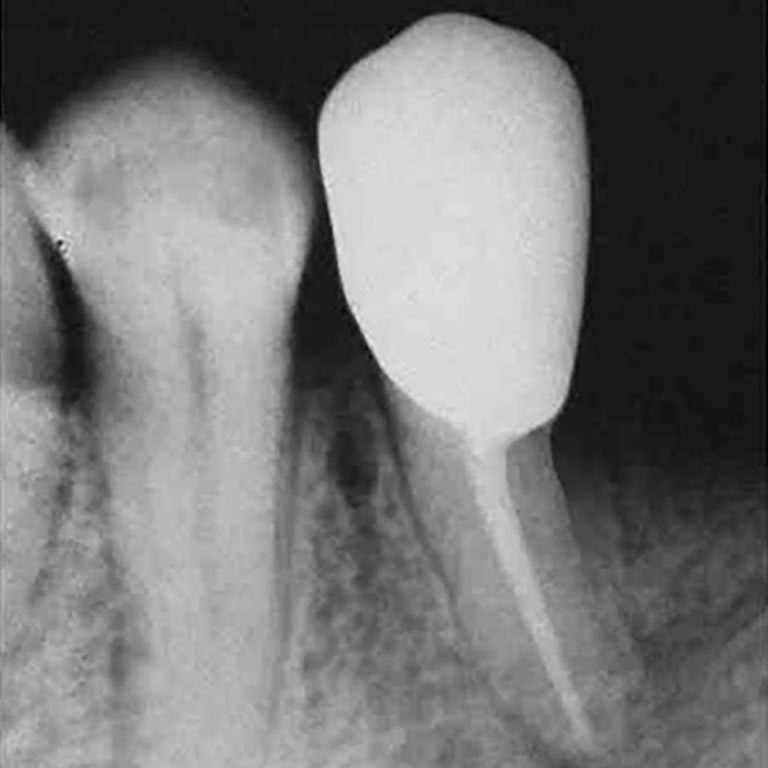 Endodoncia o Implante