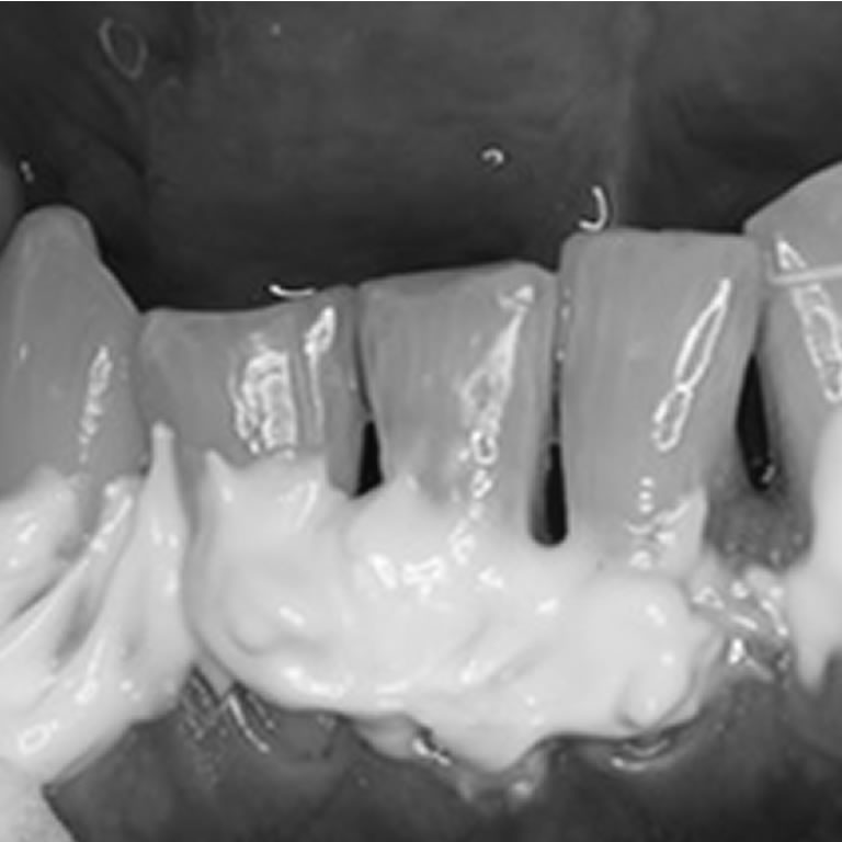 Hiperestesia Dentinaria