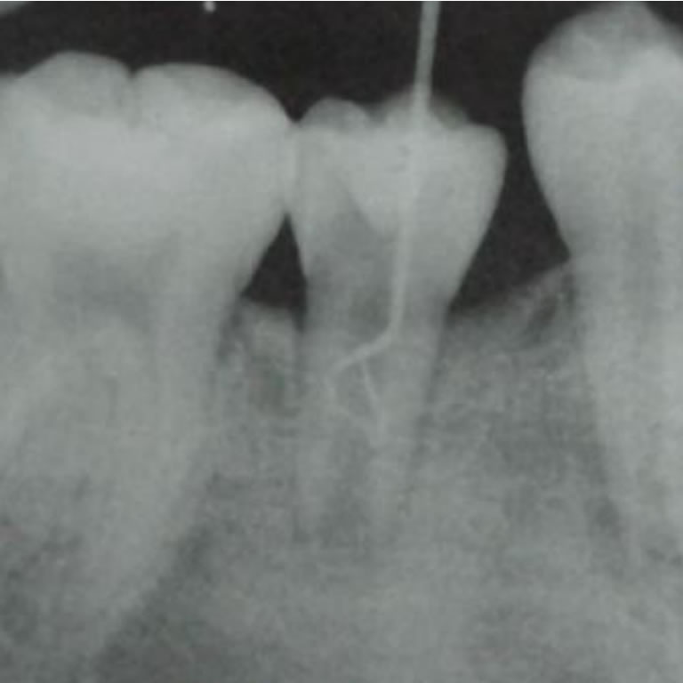 Regeneracion de Tejidos Dentario